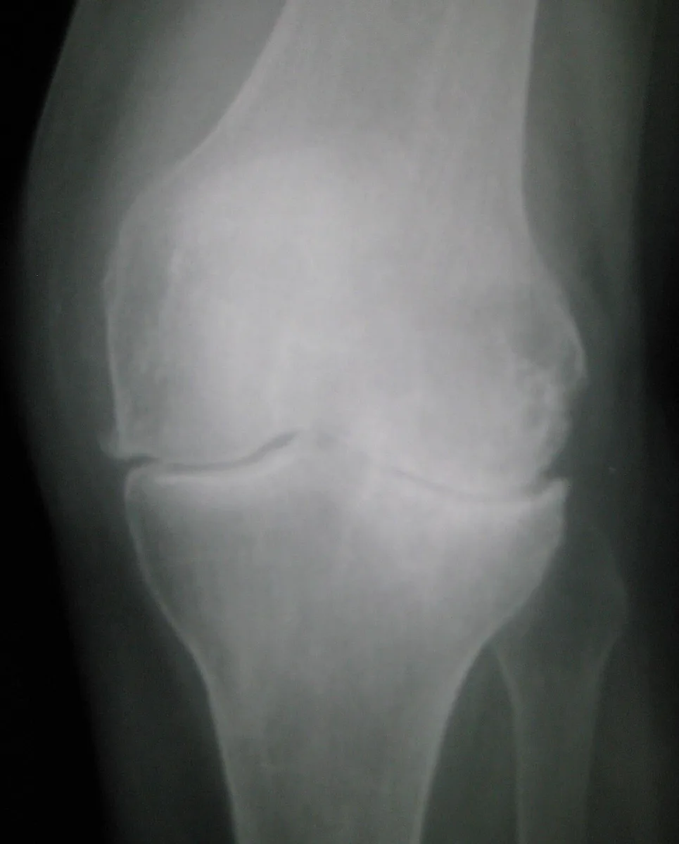 Radiografia de joelho com artrose, mostrando redução do espaço articular e osteófitos