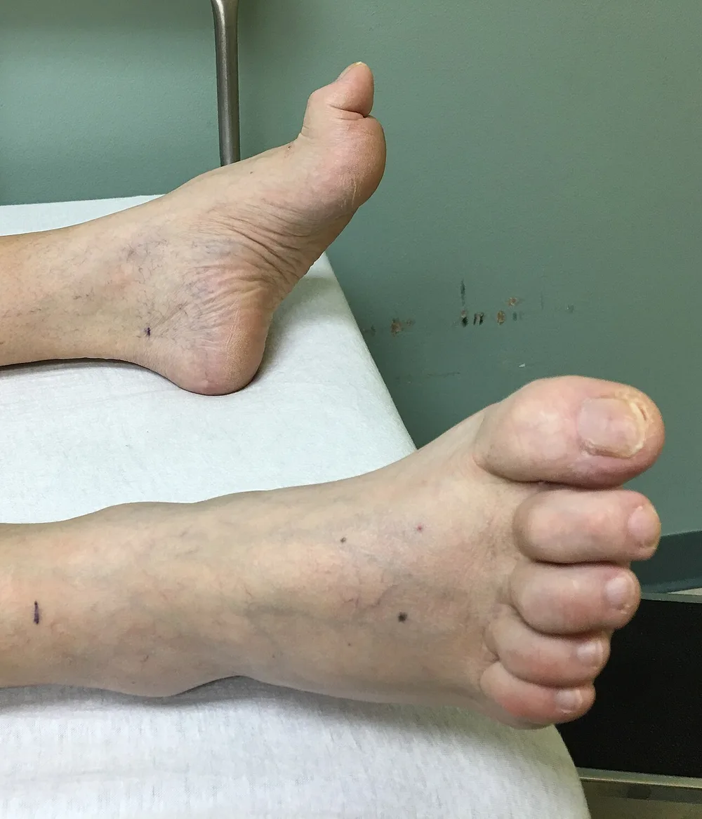 Fotografia clínica de pés com dedos em garra, mostrando as articulações dos dedos menores dobradas