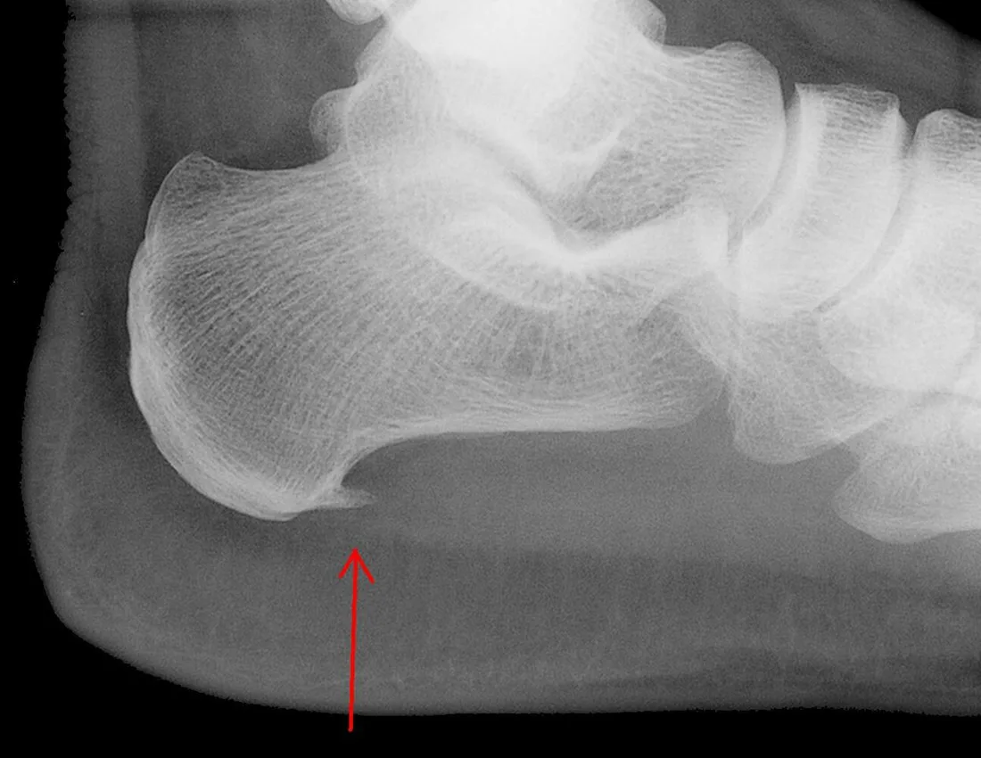 Radiografia lateral do calcanhar com esporão de calcâneo indicado por uma seta