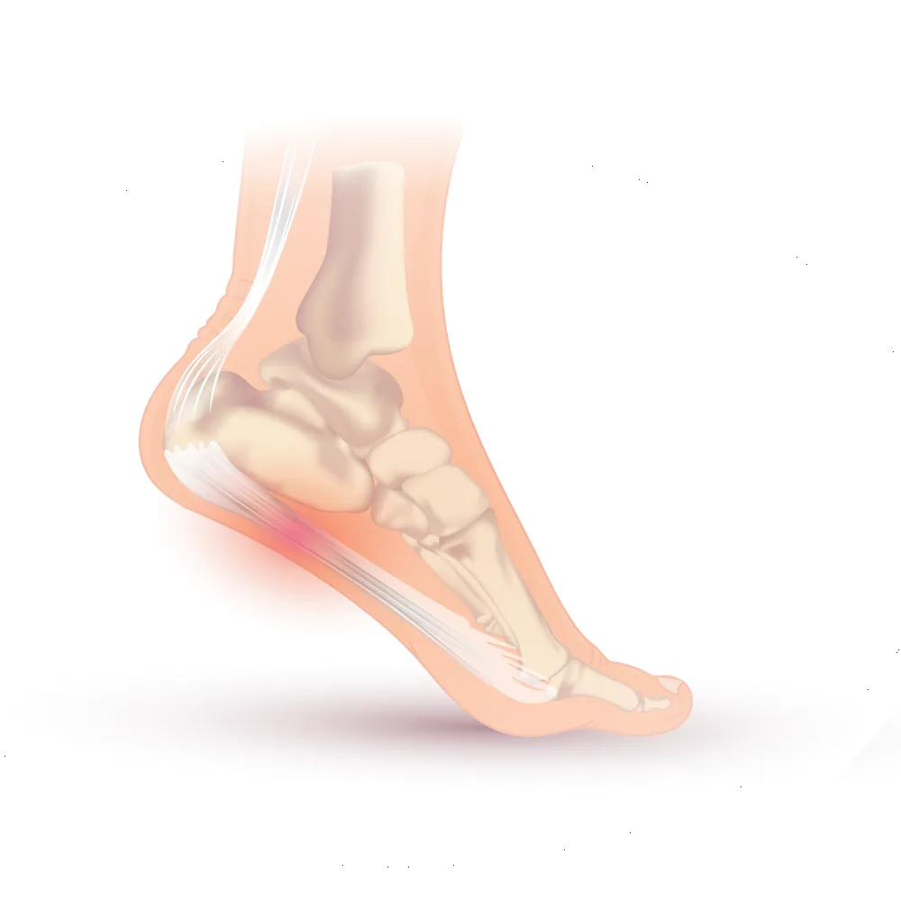 Ilustração do pé destacando a fáscia plantar e a região da dor no calcanhar