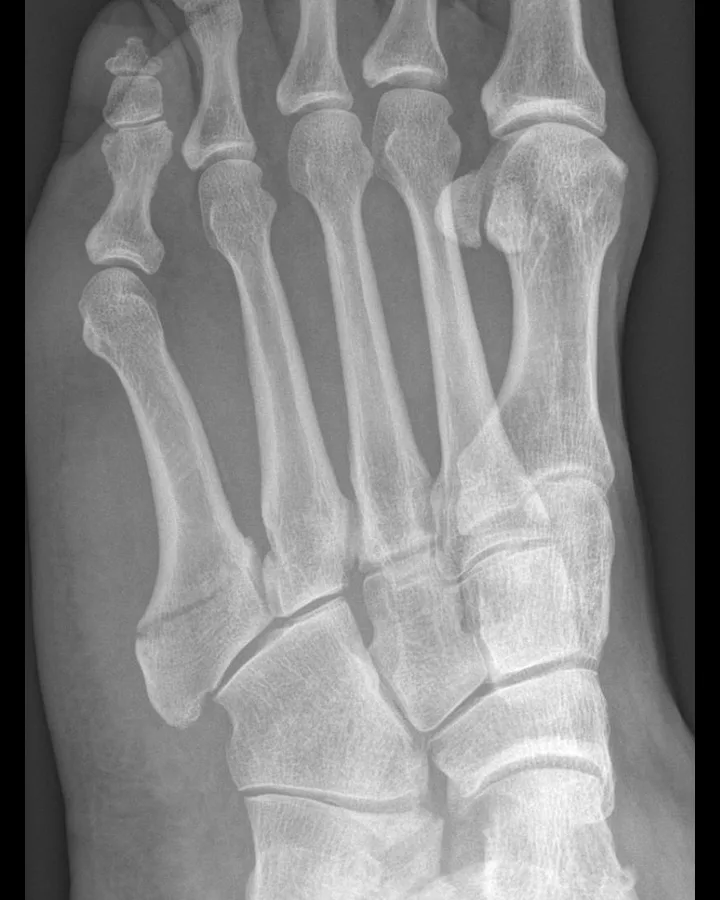 Radiografia oblíqua do pé mostrando fratura na base do quinto metatarso