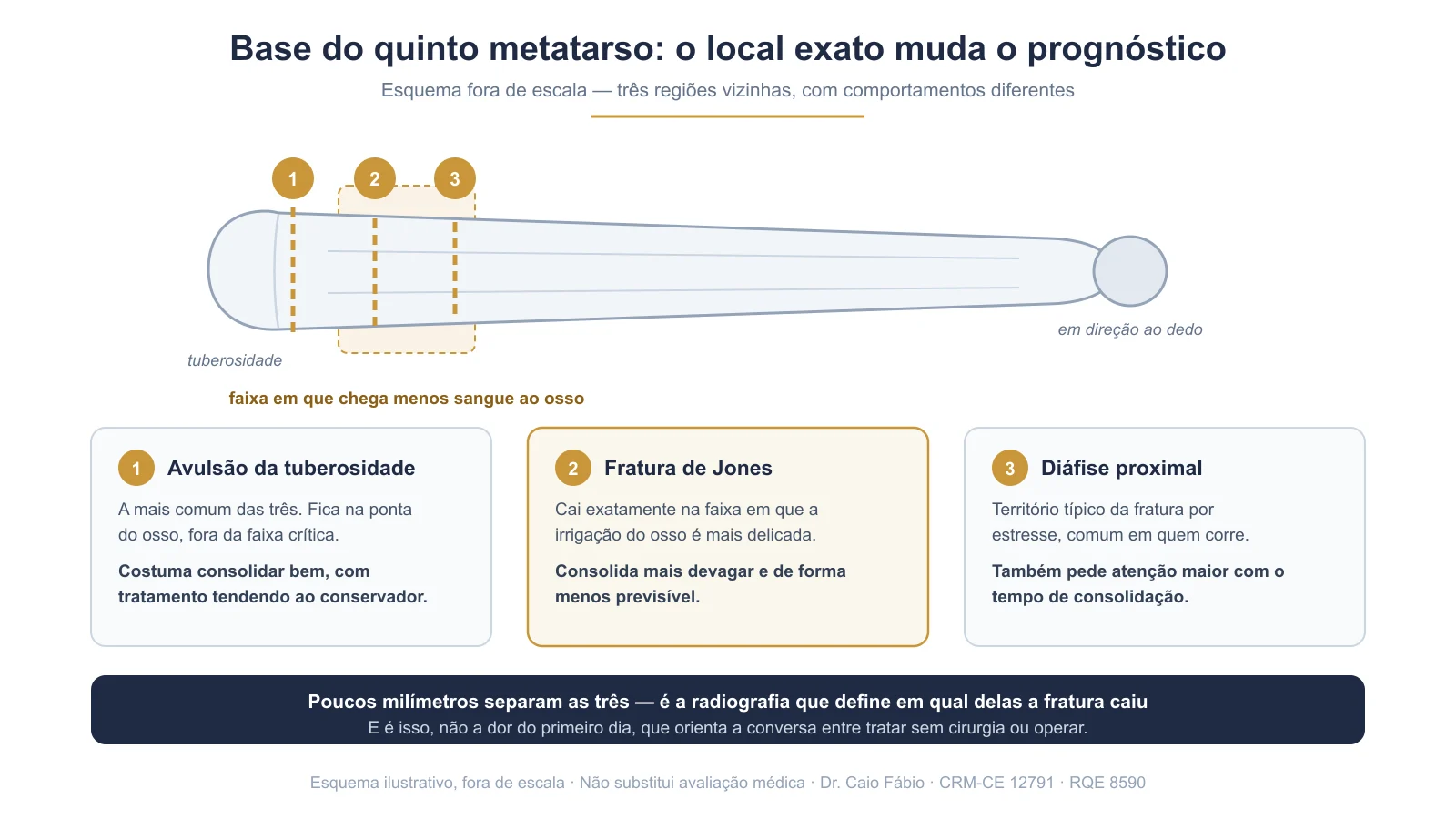 Esquema da base do quinto metatarso com as três regiões de fratura: avulsão da tuberosidade, fratura de Jones e diáfise proximal