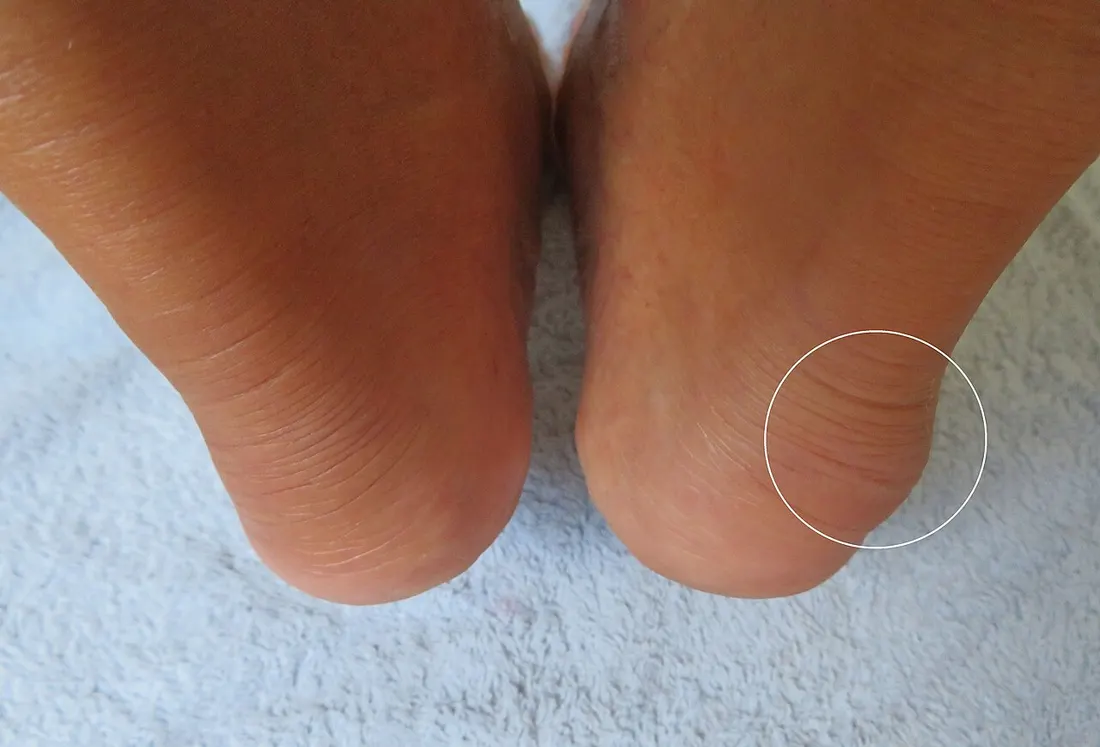 Fotografia dos dois calcanhares vistos por trás, com a saliência da deformidade de Haglund circulada em um deles e o outro normal para comparação