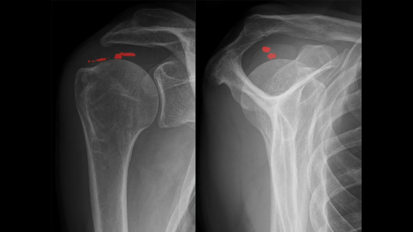 Radiografia de ombro em duas incidências com o depósito de cálcio no tendão do supraespinal destacado em vermelho