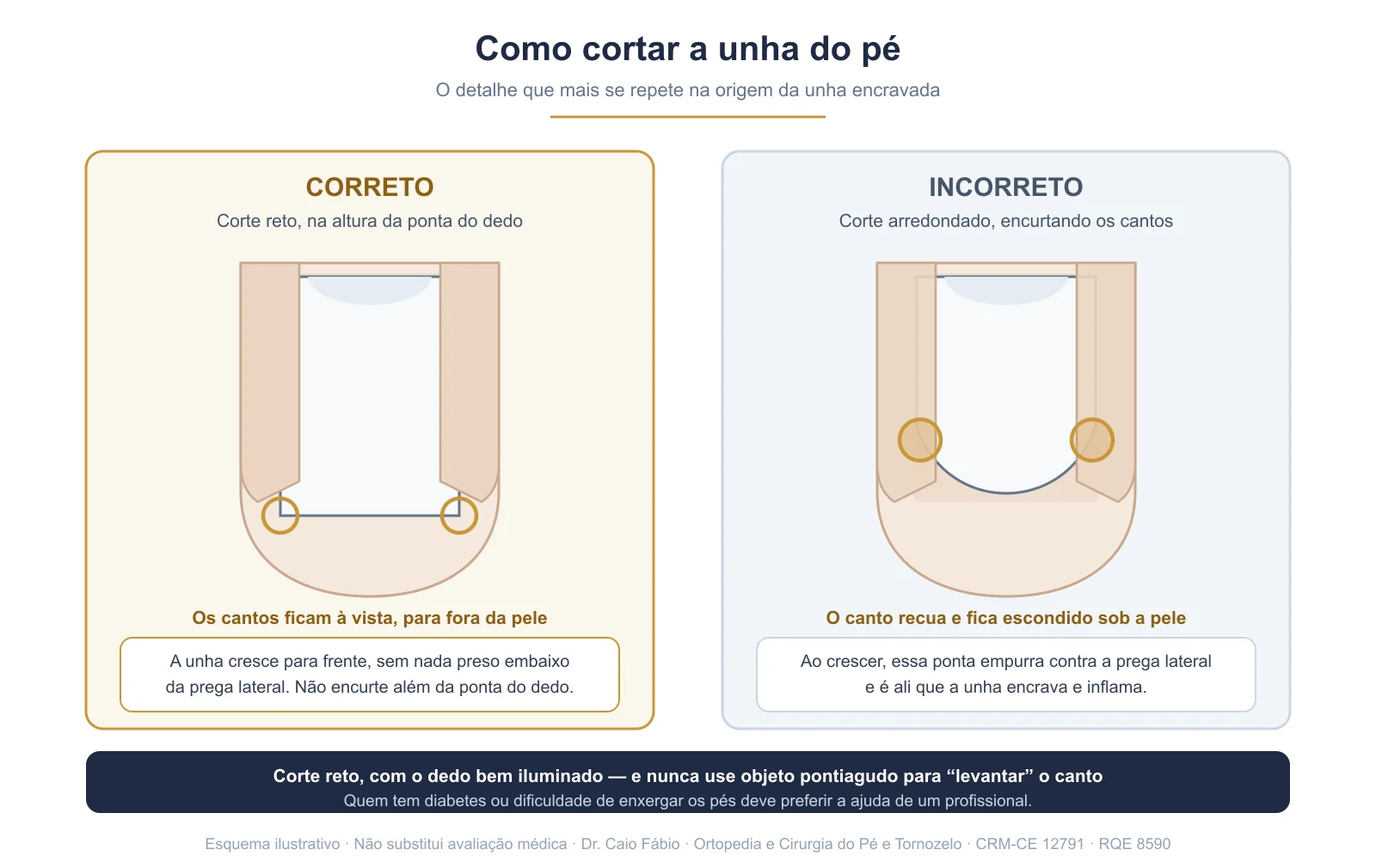 Comparação entre o corte reto da unha do pé, considerado correto, e o corte arredondado que deixa o canto preso sob a pele