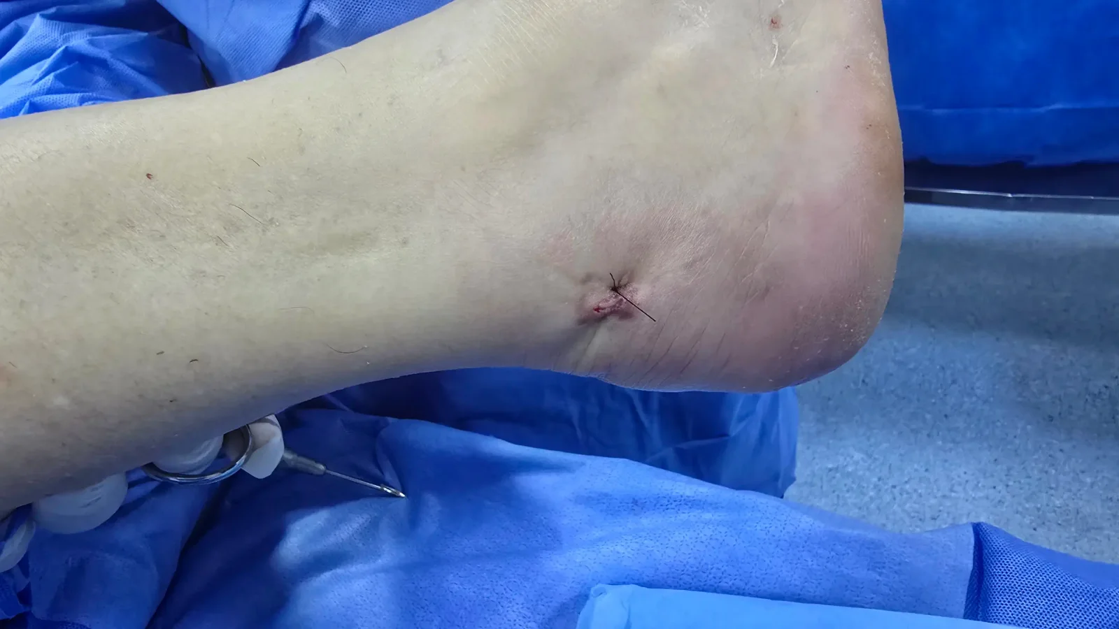 Pós-operatório imediato de calcaneoplastia minimamente invasiva, com acessos de poucos milímetros na região do calcanhar