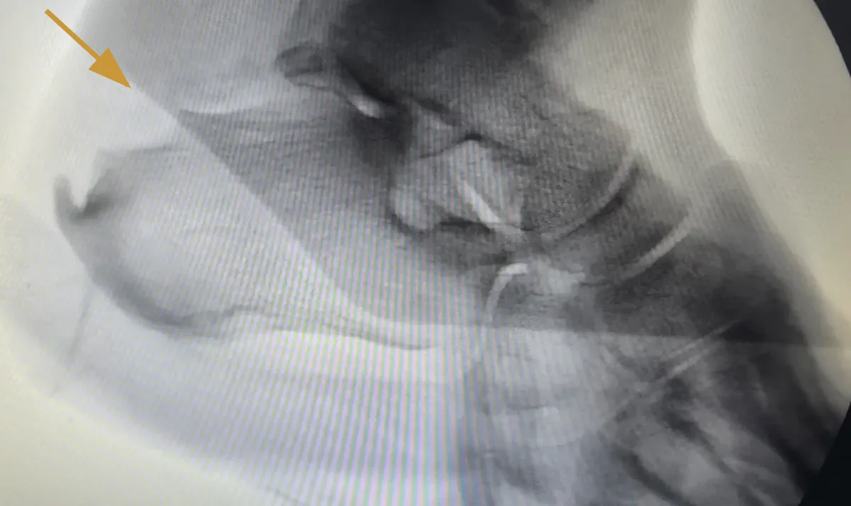Radiografia intraoperatória de calcaneoplastia minimamente invasiva de Haglund realizada pelo Dr. Caio Fábio