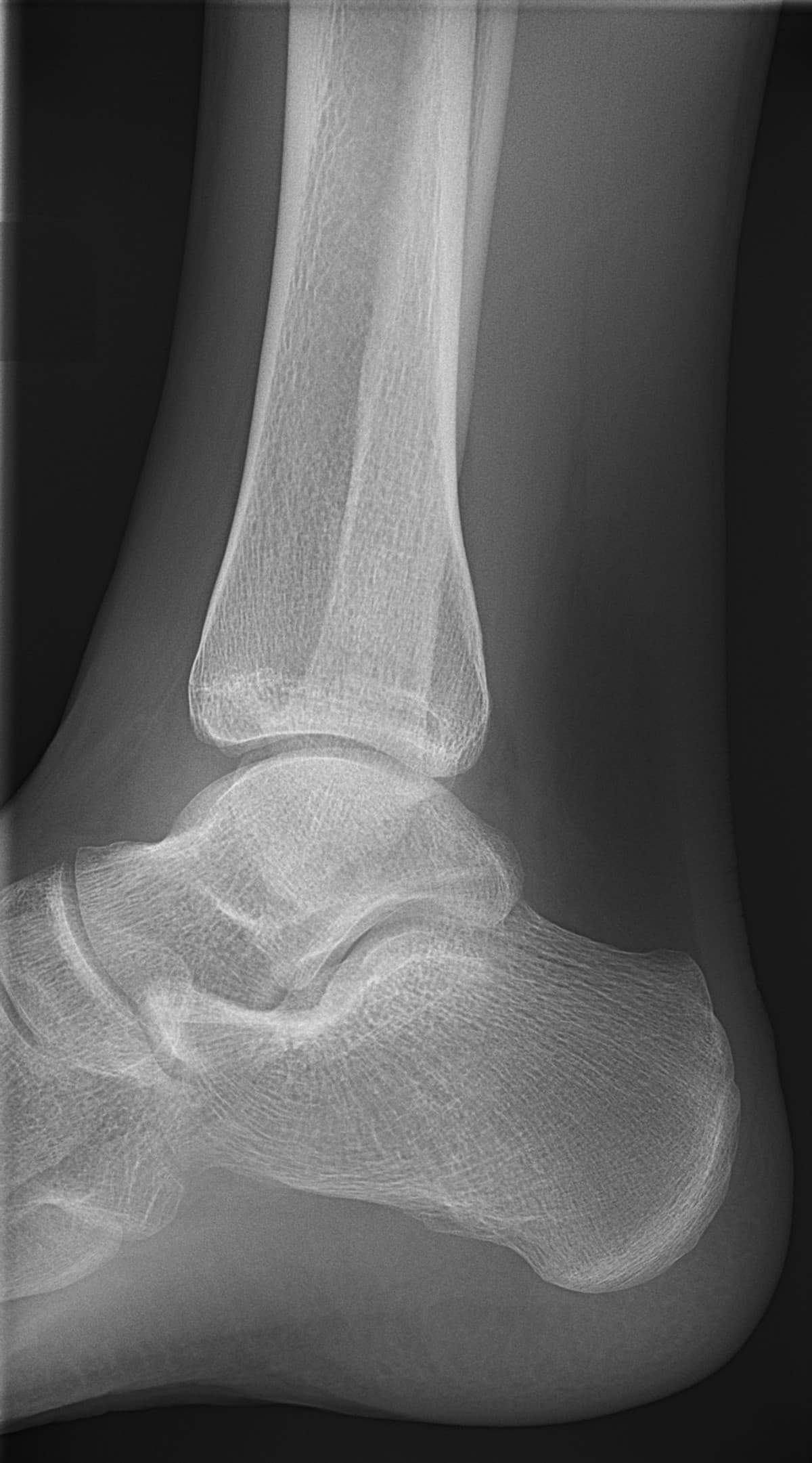 Radiografia de tornozelo em projeção lateral — imagem ilustrativa