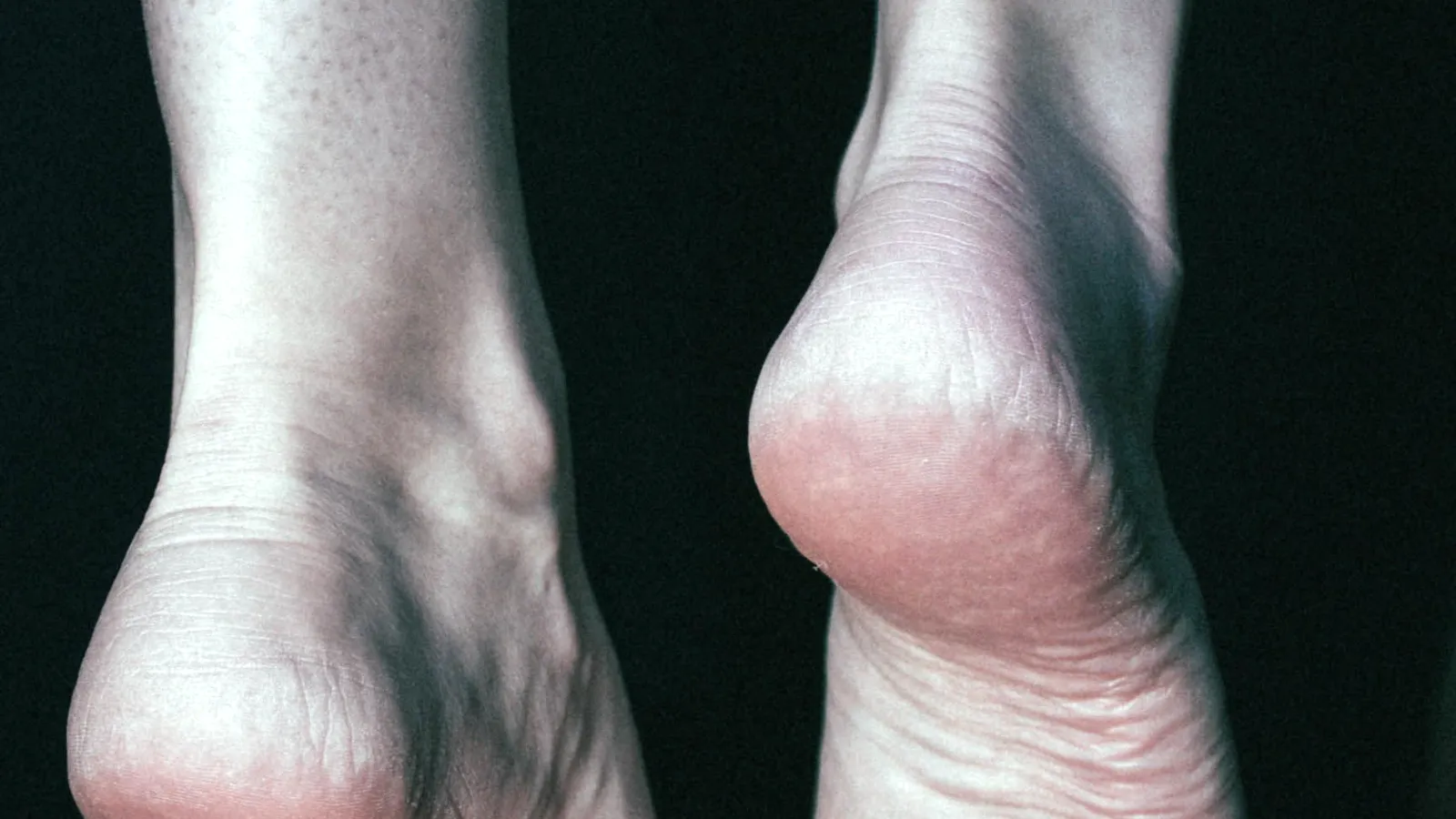 Calcanhares vistos por trás, destacando a região posterior onde se forma a deformidade de Haglund tratada por cirurgia minimamente invasiva — imagem ilustrativa